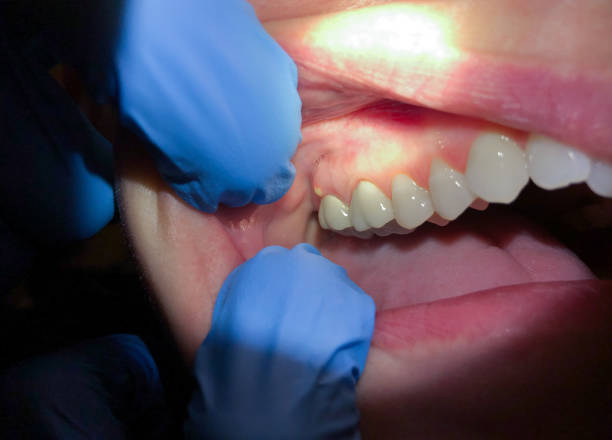 Best Emergency Gum Treatment in Walden, NY